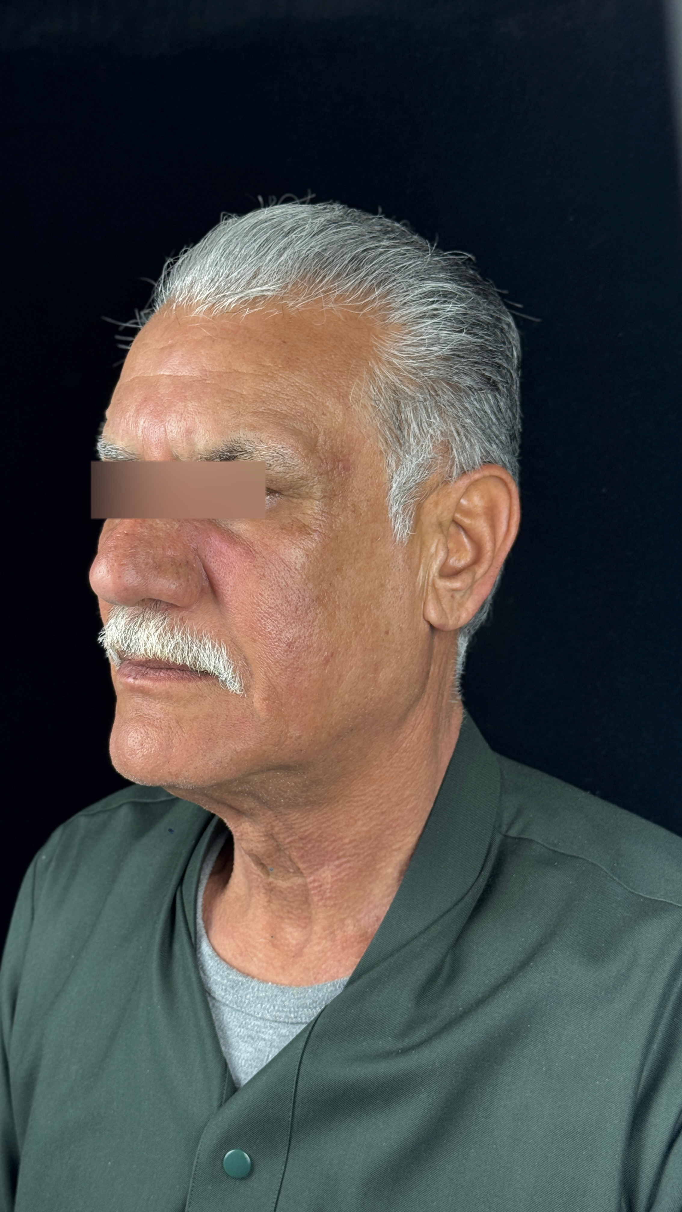 شد البشرة - بجهاز الترا كلير - بعد