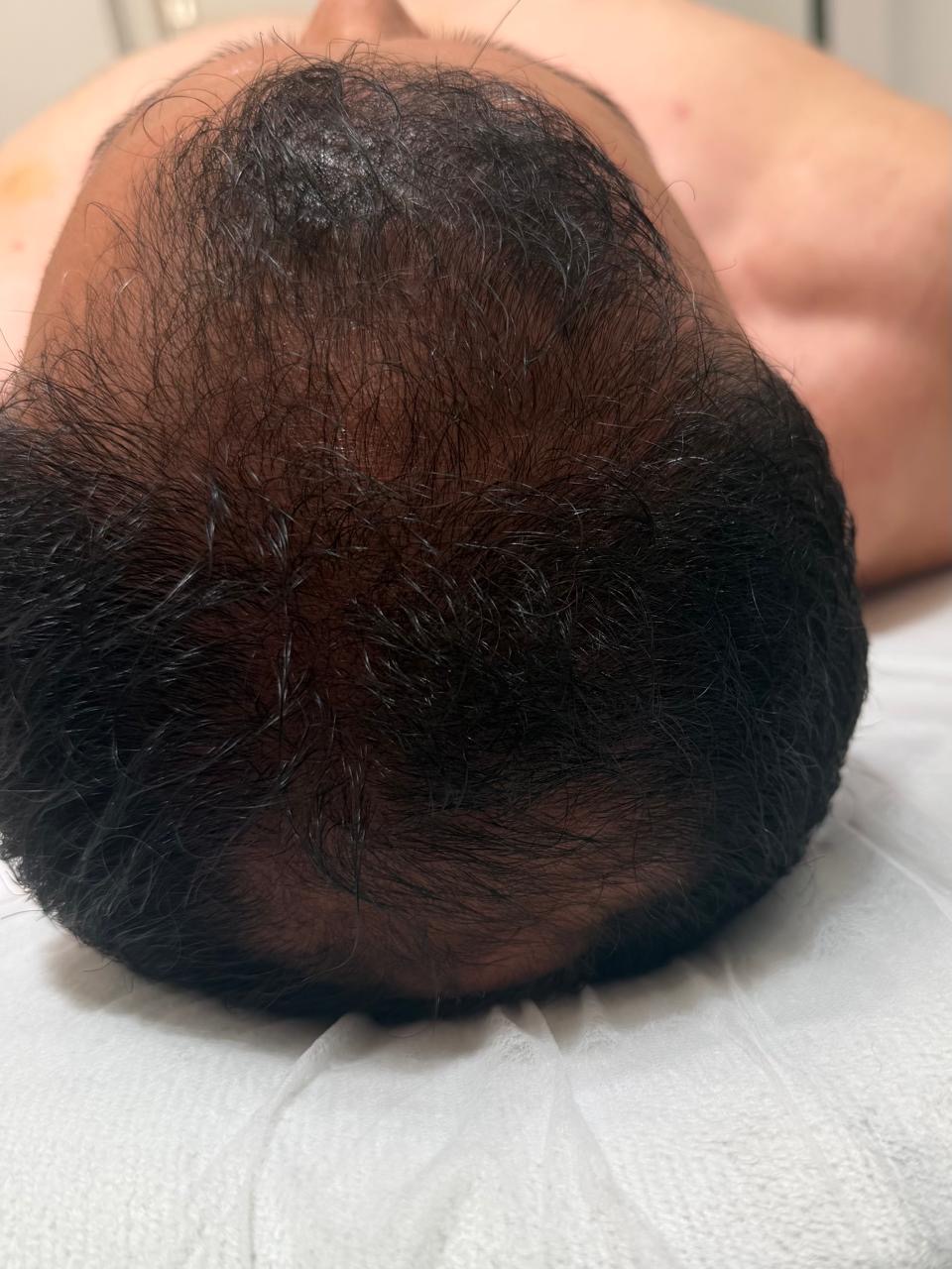علاج تساقط الشعر - بعد