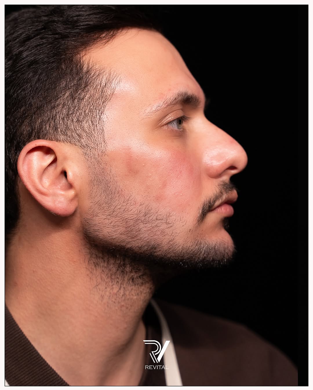 نتيجة بعد العلاج في عيادة ريفايتل