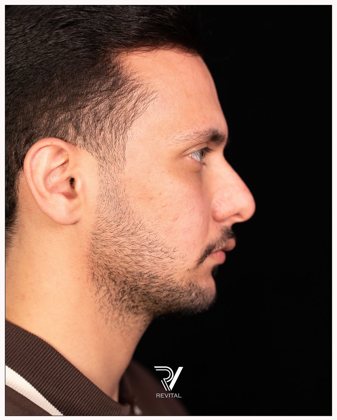 نتيجة قبل العلاج في عيادة ريفايتل