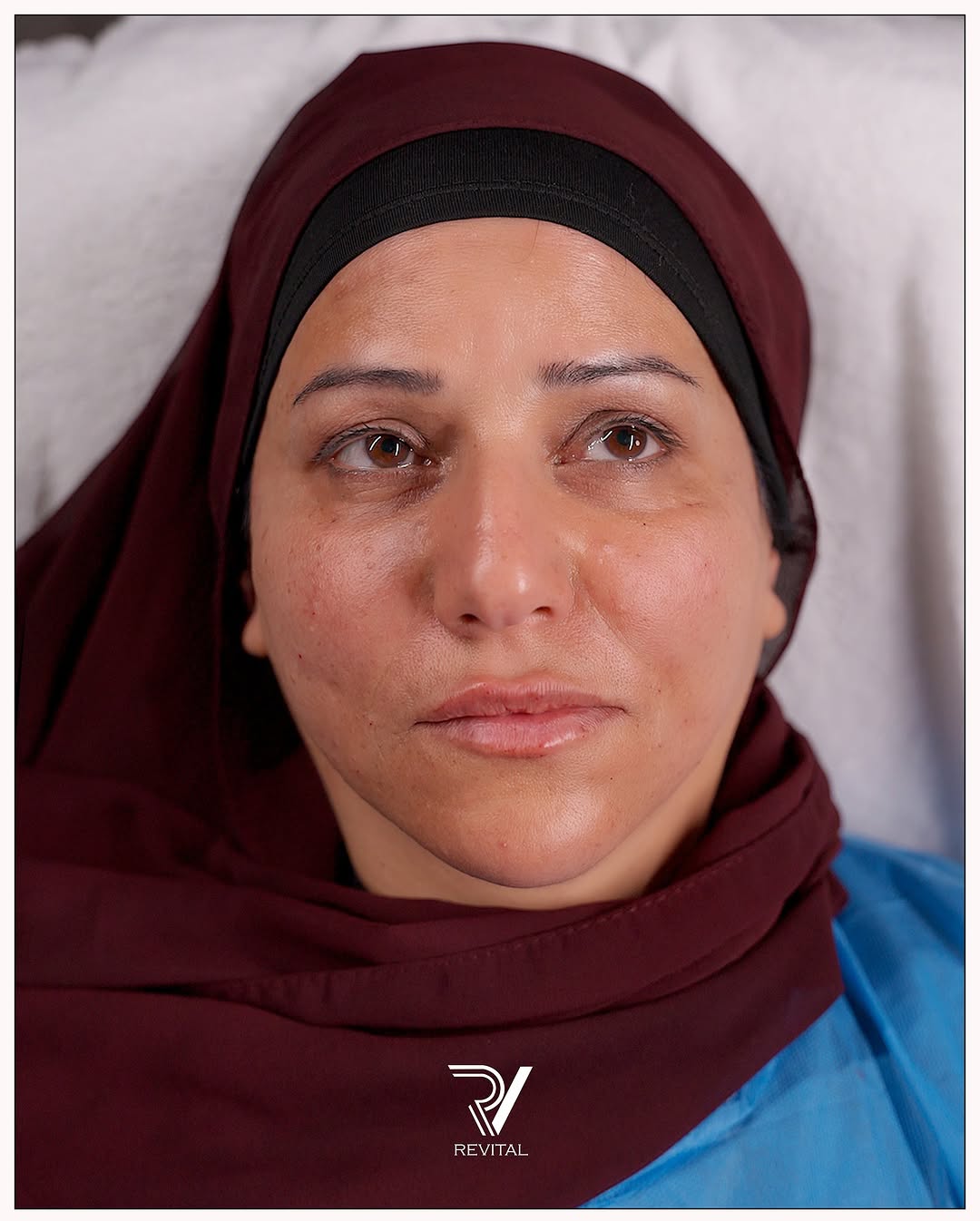 نتيجة بعد حقن الفيلر في عيادة ريفايتل