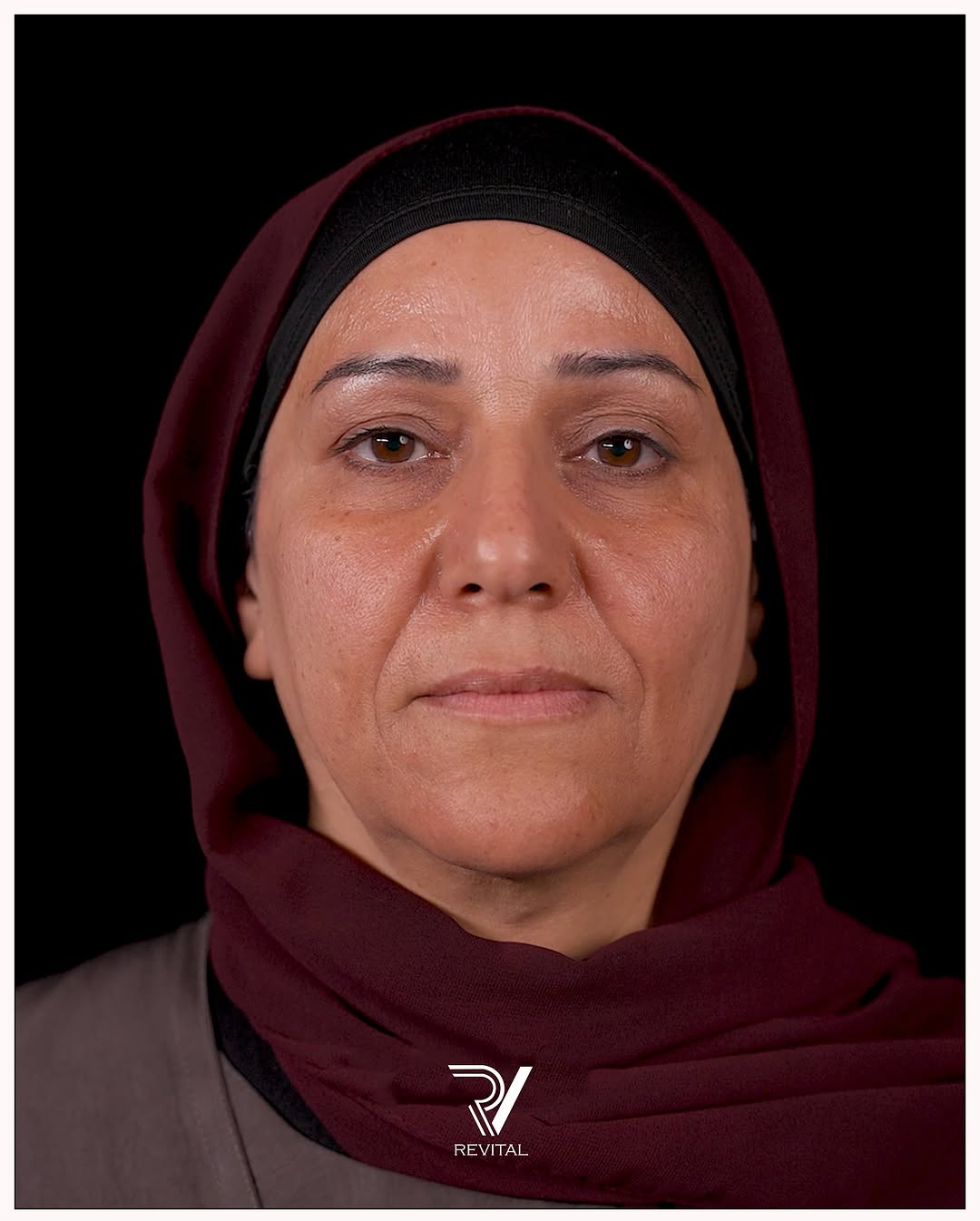 نتيجة قبل حقن الفيلر في عيادة ريفايتل