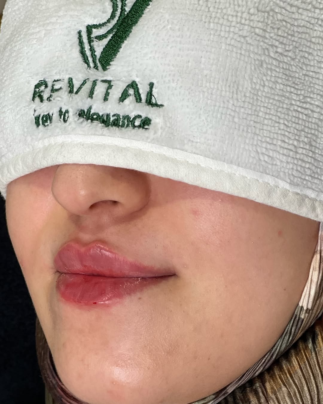 نتيجة بعد علاج حب الشباب في عيادة ريفايتل