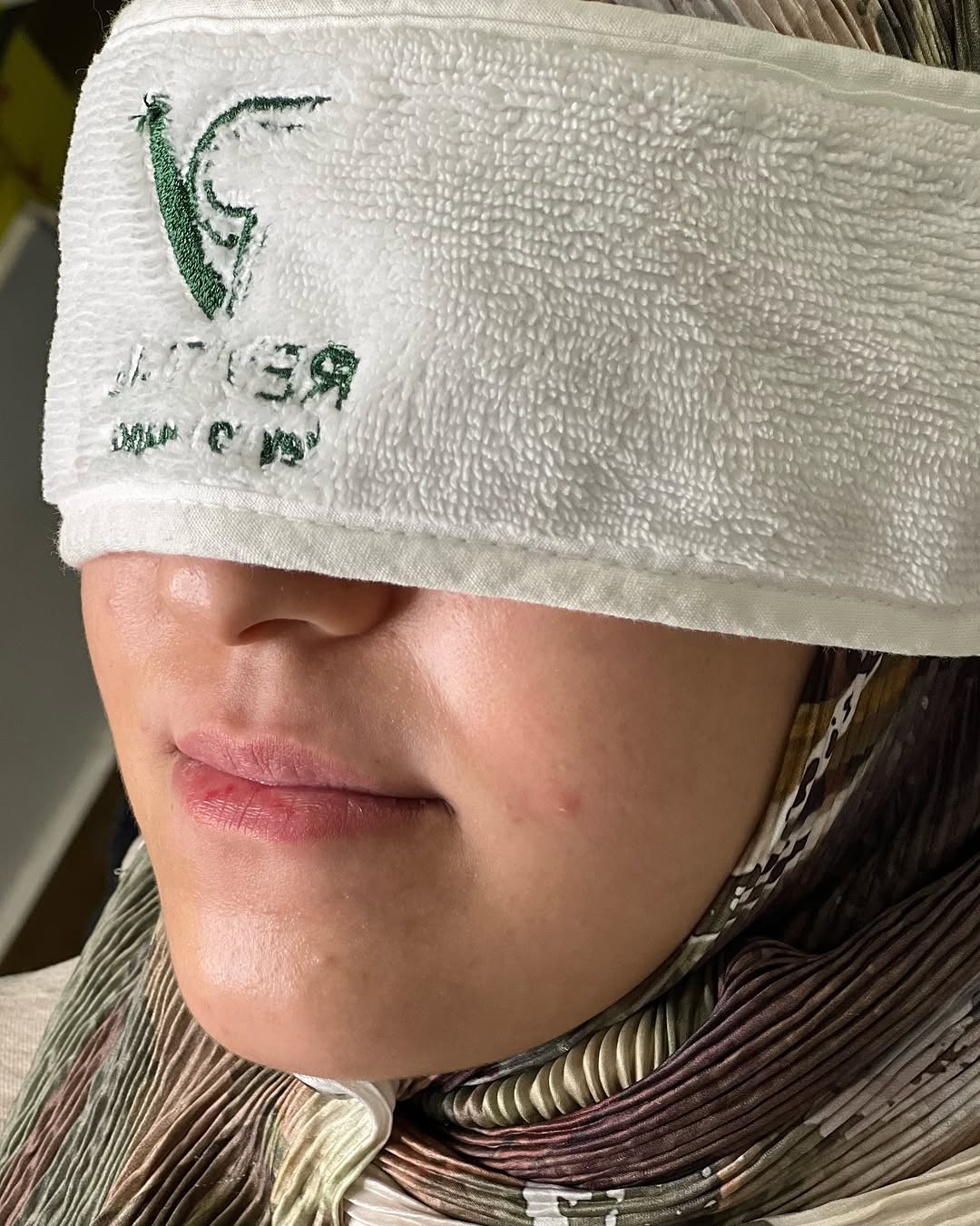 نتيجة قبل علاج حب الشباب في عيادة ريفايتل